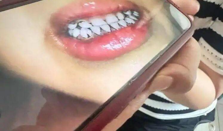 中國甘肅幼兒園鉛中毒案 官方宣布提高為省級調查